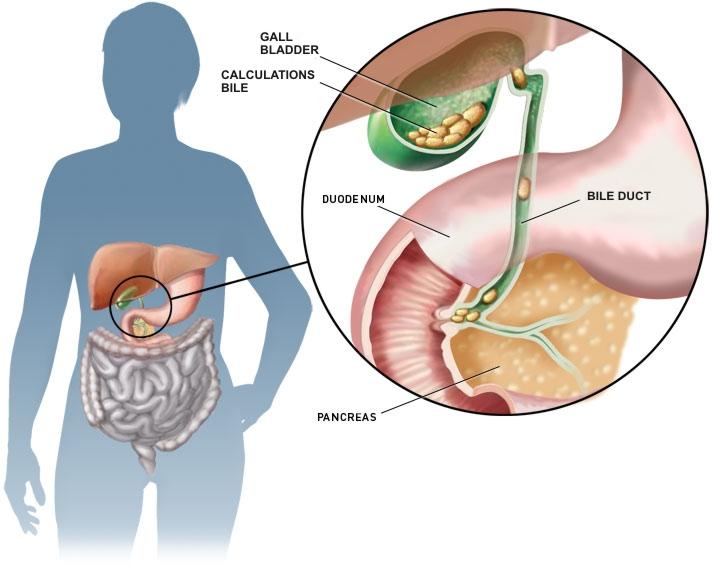 Prevention and Treatment of Gallstones